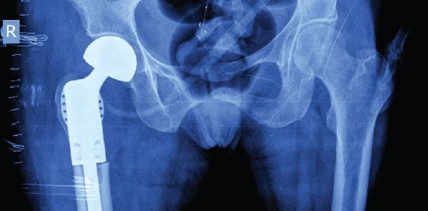 hip-replacement-prepvirtual